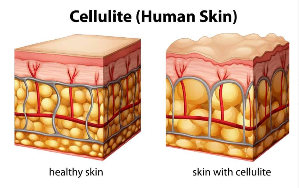 what are the foods that causes cellulite